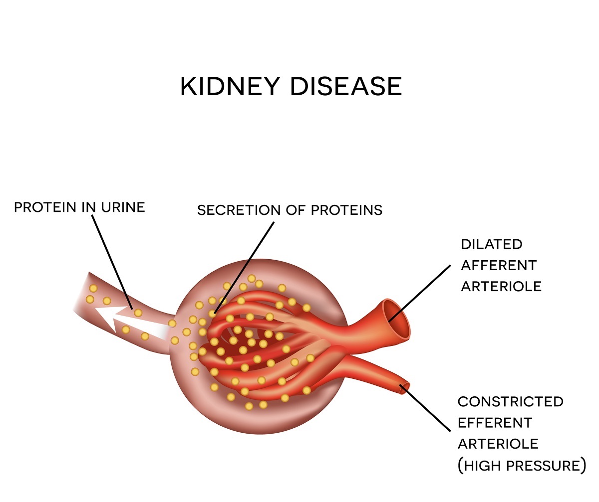 protein-in-urine-and-how-to-lower-protein-in-urine